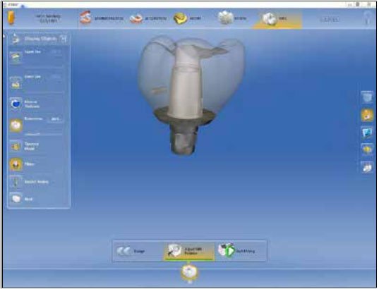 multilink hybrid abutment cement instructions